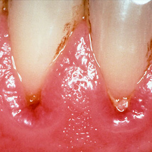 치은염의 발생 원인은