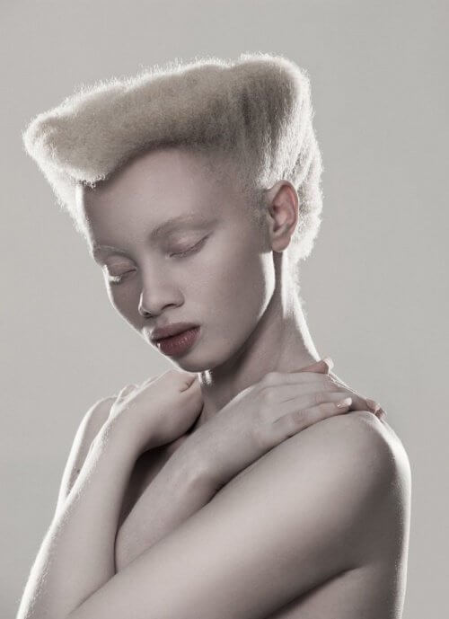 modell med albinisme