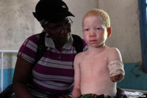 gutt med albinisme