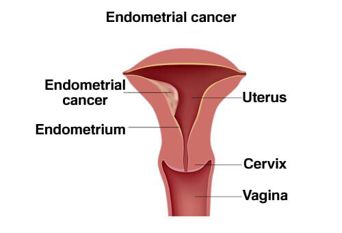 자궁암에 대해 기억해야 할 5가지