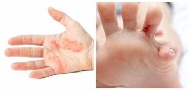 Dyshidrotic Dermatitis Symptoms Causes Diagnosis And The Best Porn