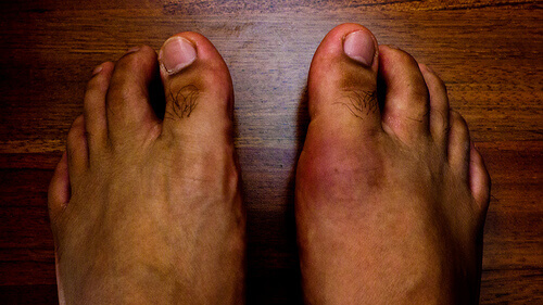 Gout: 8 Foods that Can Cause It
