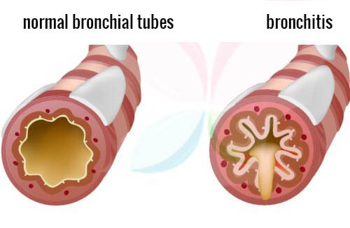 How To Get Rid Of Bronchitis Naturally