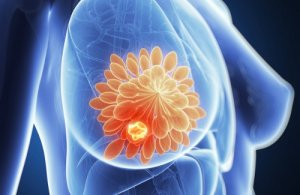 A Diet That May Help Prevent Breast Cysts