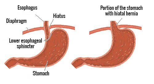 Hill Hiatal Hernia