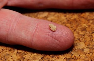 Home Remedies for Kidney Stones