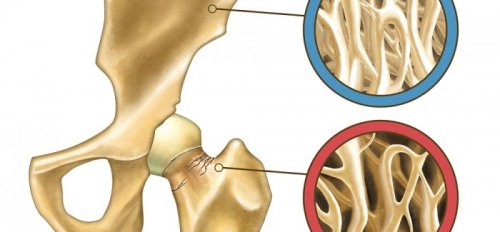 Natural Prevention of Osteoporosis