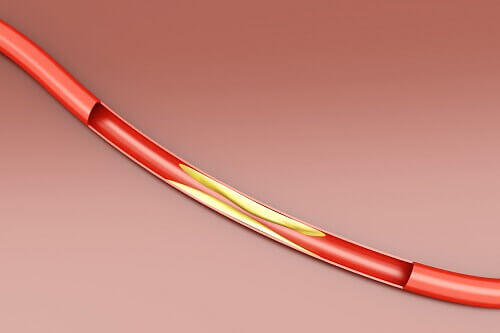 Colesterol en las arterias