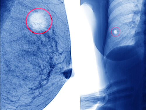 Röntgen av bröstcystor