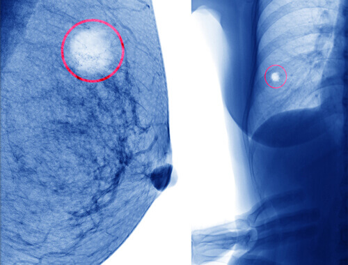 X-ray of a Mammary Cysts