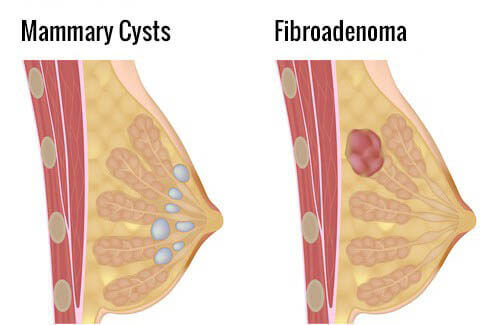 How Do I Prevent Mammary Cysts Step To Health