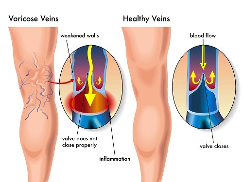 Home Remedies for Varicose Veins Home Remedies for Varicose Veins