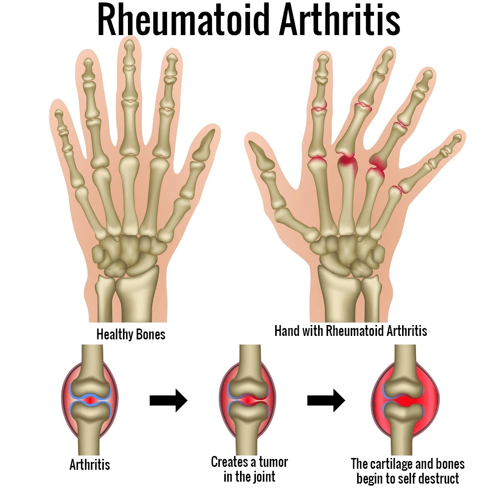 rheumatoid arthritis természetes kezelése