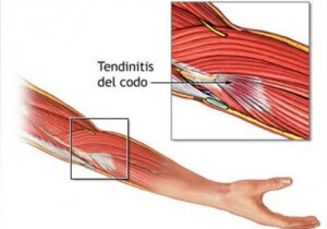 Senebetennelse på albuen