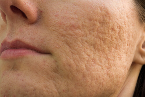 It's important to deal with acne scars and skin health.