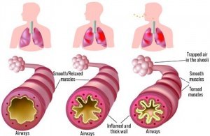 What to Do if You Suffer from Chronic Asthma or Allergies