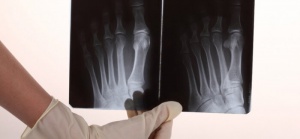 Home Remedies for Bone and Joint Pain