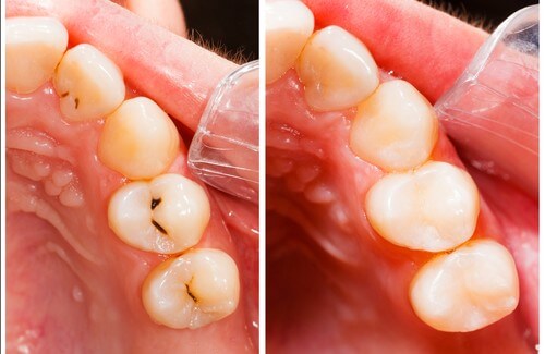 Cavities: Causes and Natural Treatments Cavities: Causes and Natural Treatments