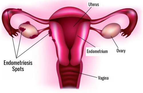 Endometriosis1-500x325 copy