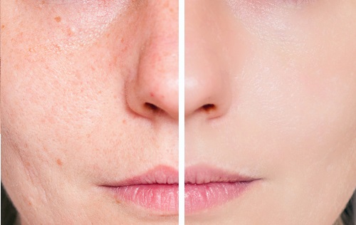 Acne Scars and Skin Health