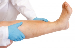 Leg Swelling: Causes and Cures