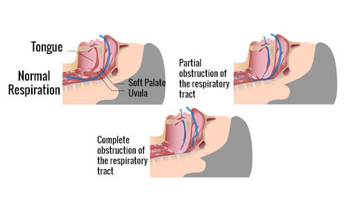 How snoring works