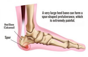 How to Prevent Heel Spurs