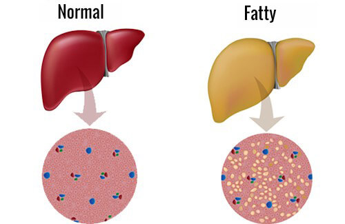 Fighting a Fatty Liver: Here's our Advice