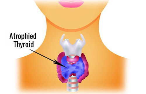 graphic representation of hypothyroidism