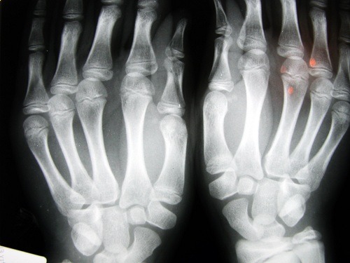 Osteoarthritis.