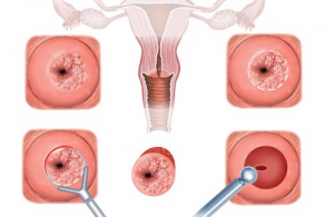 The Symptoms and Treatment of Cervical Erosion