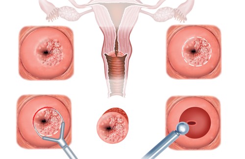 cervical erosion
