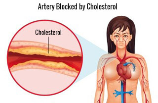 How to Control Your Cholesterol How to Control Your Cholesterol