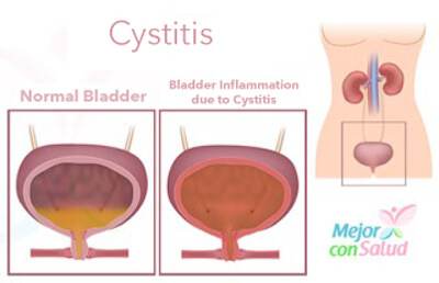 Pain when urinating caused by cystitis