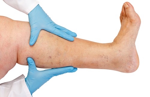 Ten Pieces of Advice for Preventing Fluid Retention Ten Pieces of Advice for Preventing Fluid Retention