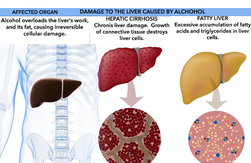 effects of alcohol on liver