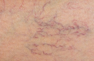 Indian Horse-Chestnuts: A Possible Ally Against Varicose Veins