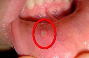 Natural Home Remedies to Fight Canker Sore