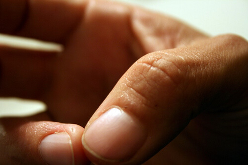 eczema