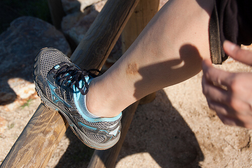 Eczema-on-leg