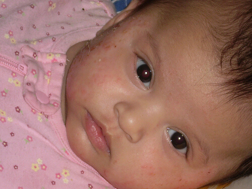eczema-on-baby