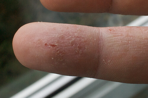eczema-on-finger