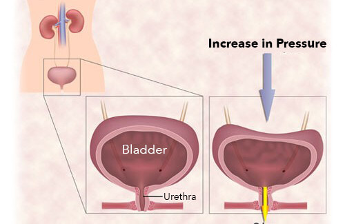Urinary incontinence diagram