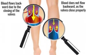 How to Improve Arm and Leg Circulation