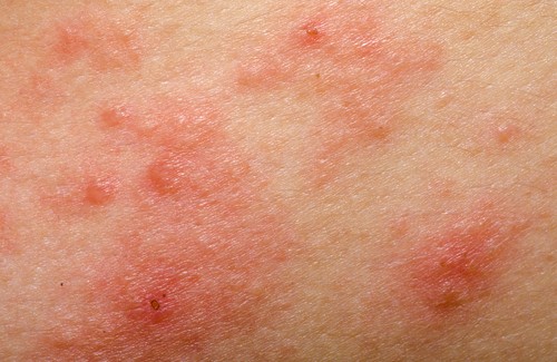 Natural Treatments for Rosacea Natural Treatments for Rosacea