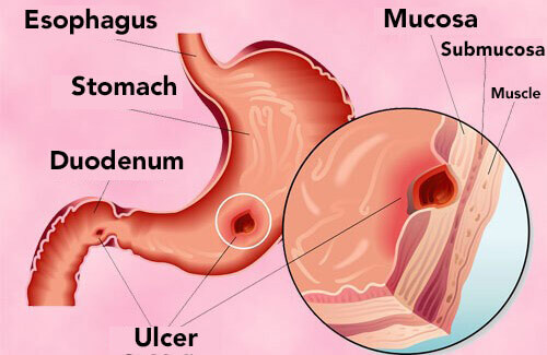 Natural Treatment for Stomach Ulcers