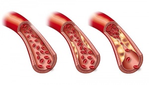 Reduce High Triglycerides Naturally