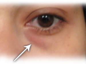 Home Remedy for Treating Eye Bags