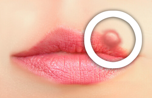 How to Possibly Prevent Herpes Labialis