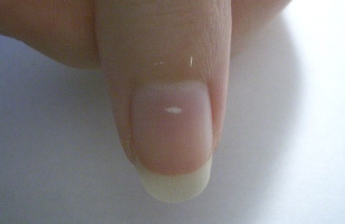 What Do The White Marks on Your Fingernails Mean?
